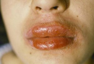allergicheskiy-stomatit-foto
