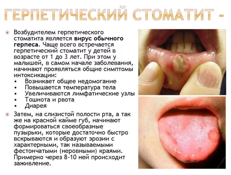 Через сколько дней проходит стоматит? 📌 | Лучший сайт о стоматите