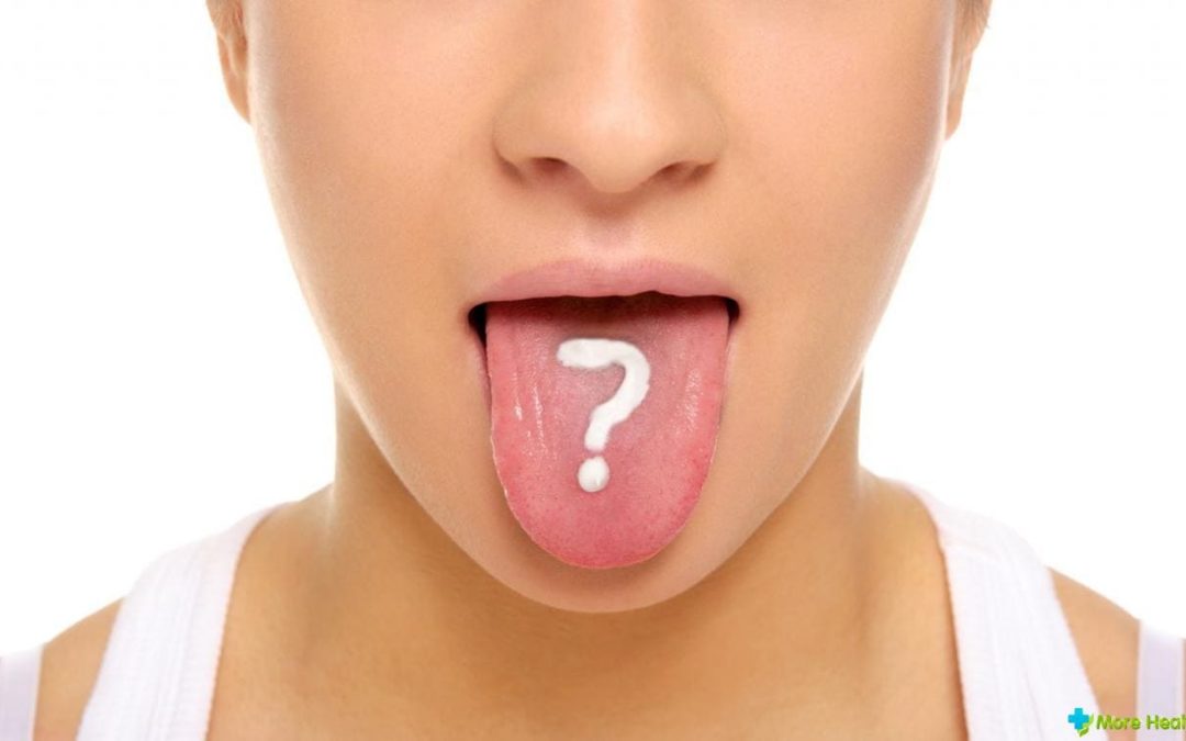 Стоматит на языке у взрослых 👅- лечение препаратами, симптомы, причины, фото стоматита